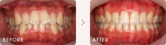 舌側（裏側）矯正による出っ歯とでこぼこの改善例 写真a