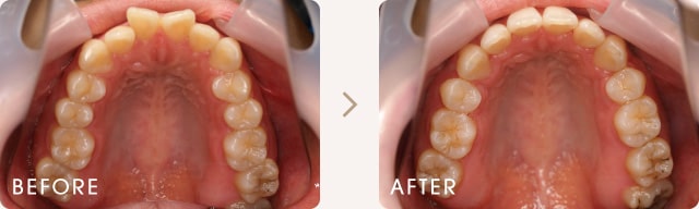 舌側（裏側）矯正による出っ歯とでこぼこの改善例 写真b