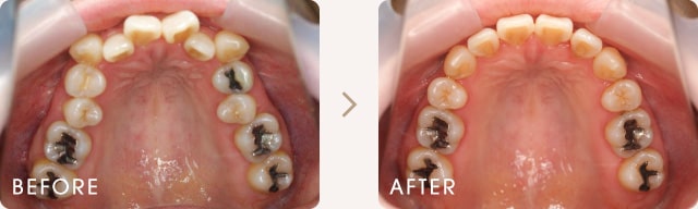 八重歯と前歯のでこぼこの改善例 写真b