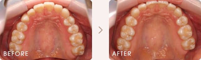 出っ歯と正中線のずれの改善例 写真b