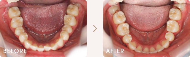 ハーフリンガルによる前歯のでこぼこの改善例 写真c