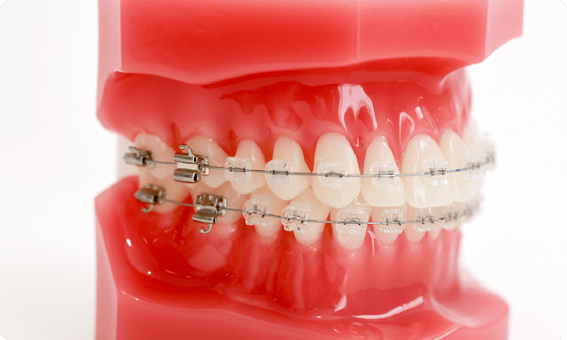 前歯のねじれがある場合 使用装置例：ブラケット 写真